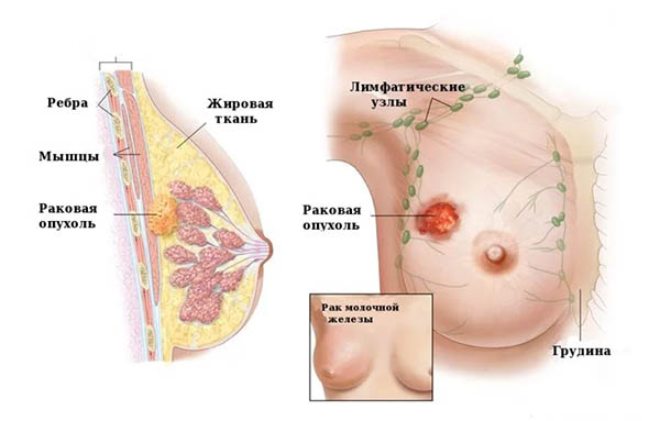 наследственность и рак груди